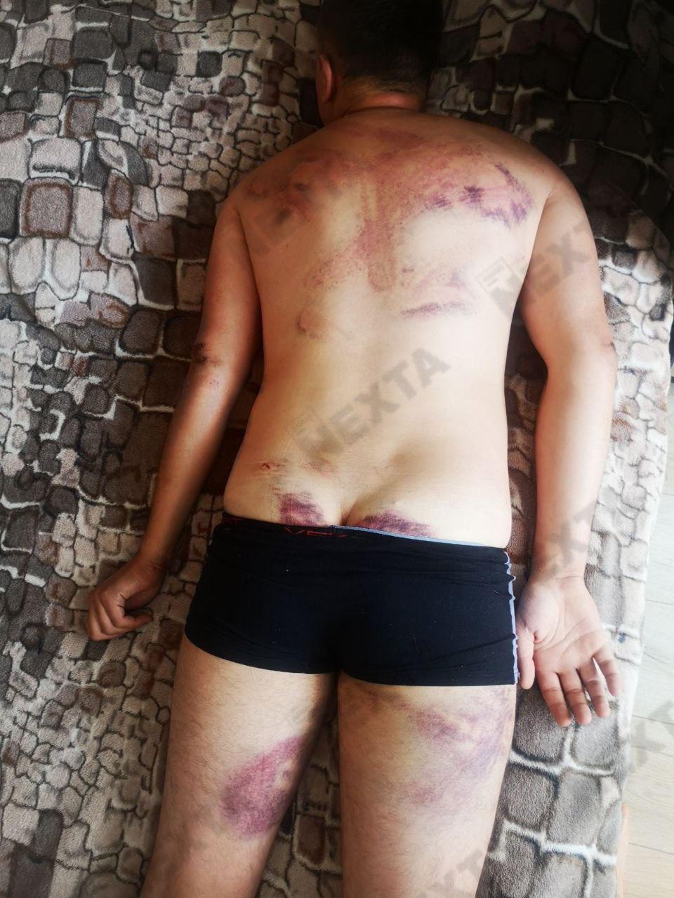 В сети показали ужасающие снимки избитых людей в Беларуси: фото 18+